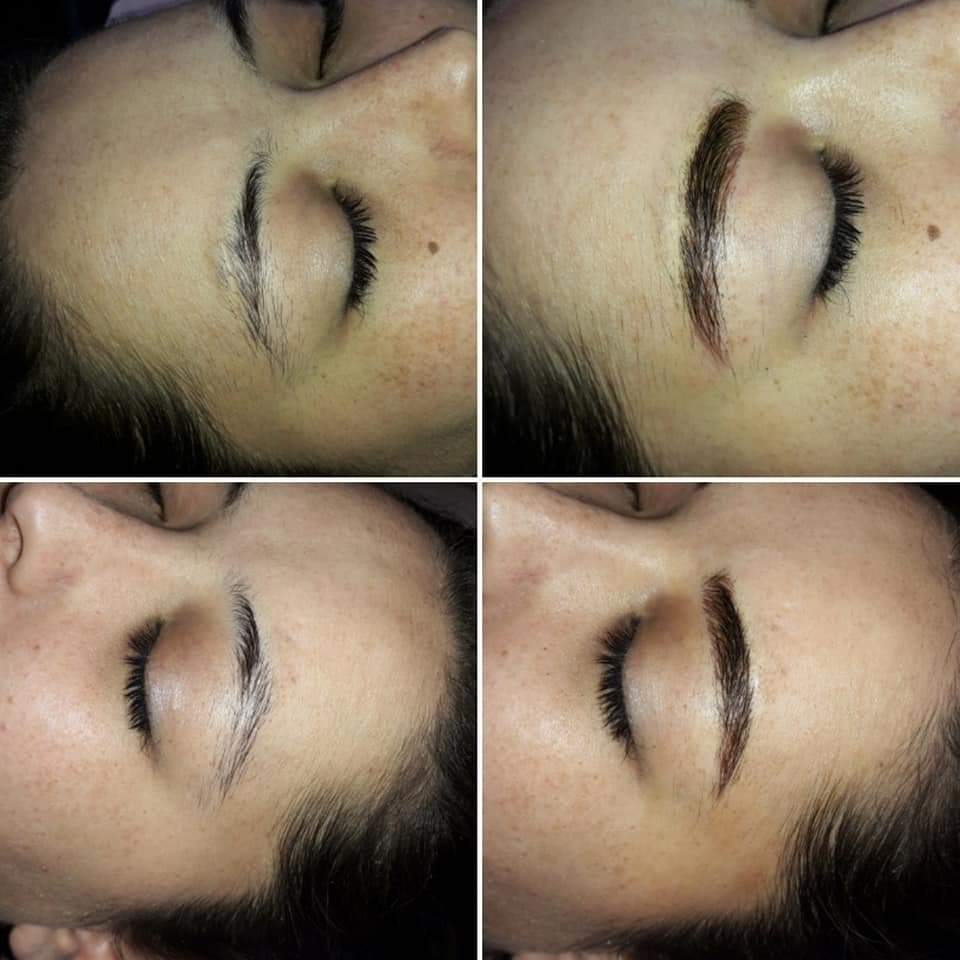 Four-panel brow comparison
